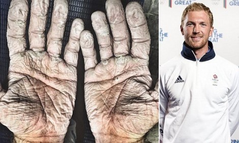 Η σοκαριστική φωτογραφία με τα χέρια Ολυμπιονίκη μετά από 965χλμ. κωπηλασίας