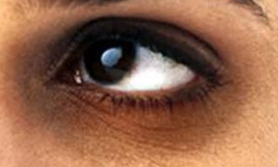 Μαύροι κύκλοι και πώς να τους αντιμετωπίσετε