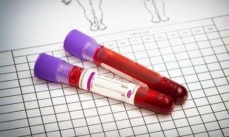 Αιματοκρίτης: Τι σημαίνει όταν είναι υψηλός και τι όταν είναι χαμηλός