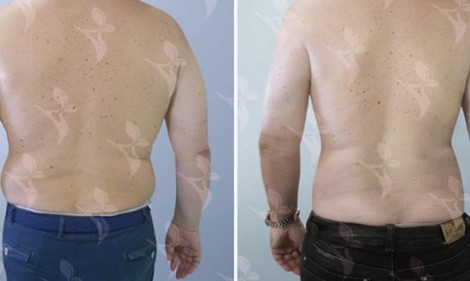 &Tau;&iota; &epsilon;ί&nu;&alpha;&iota; &tau;&omicron; EMSculpting;