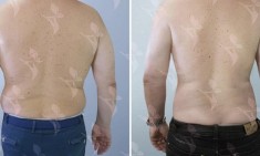 &Tau;&iota; &epsilon;ί&nu;&alpha;&iota; &tau;&omicron; EMSculpting;