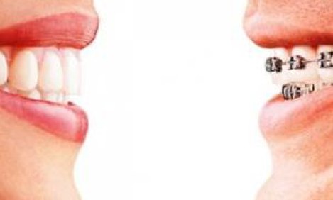 Invisalign, &eta; "&alpha;ό&rho;&alpha;&tau;&eta;" &omicron;&rho;&theta;&omicron;&delta;&omicron;&nu;&tau;&iota;&kappa;ή &tau;&omicron;&upsilon; &Phi;ώ&tau;&eta; &Kappa;&alpha;&rho;&beta;&omicron;ύ&nu;&eta;
