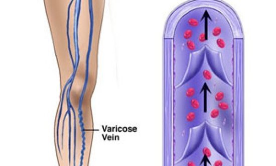 Δωρεάν ιατρικές εξετάσεις για τις φλεβικές παθήσεις