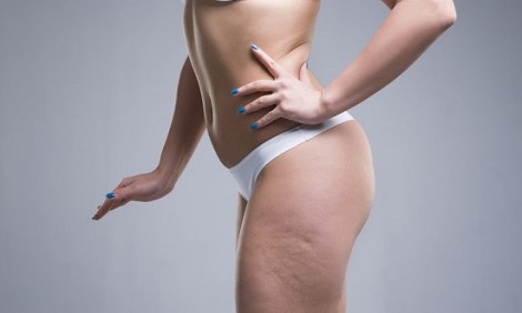 5 τροφές που προκαλούν κυτταρίτιδα