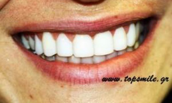 Όψεις Ρητίνης: Τι είναι και πως κατασκευάζονται; του Φώτη Καρβούνη