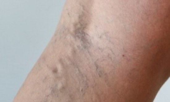 Φλεβίτιδα; Δείτε τι να κάνετε!